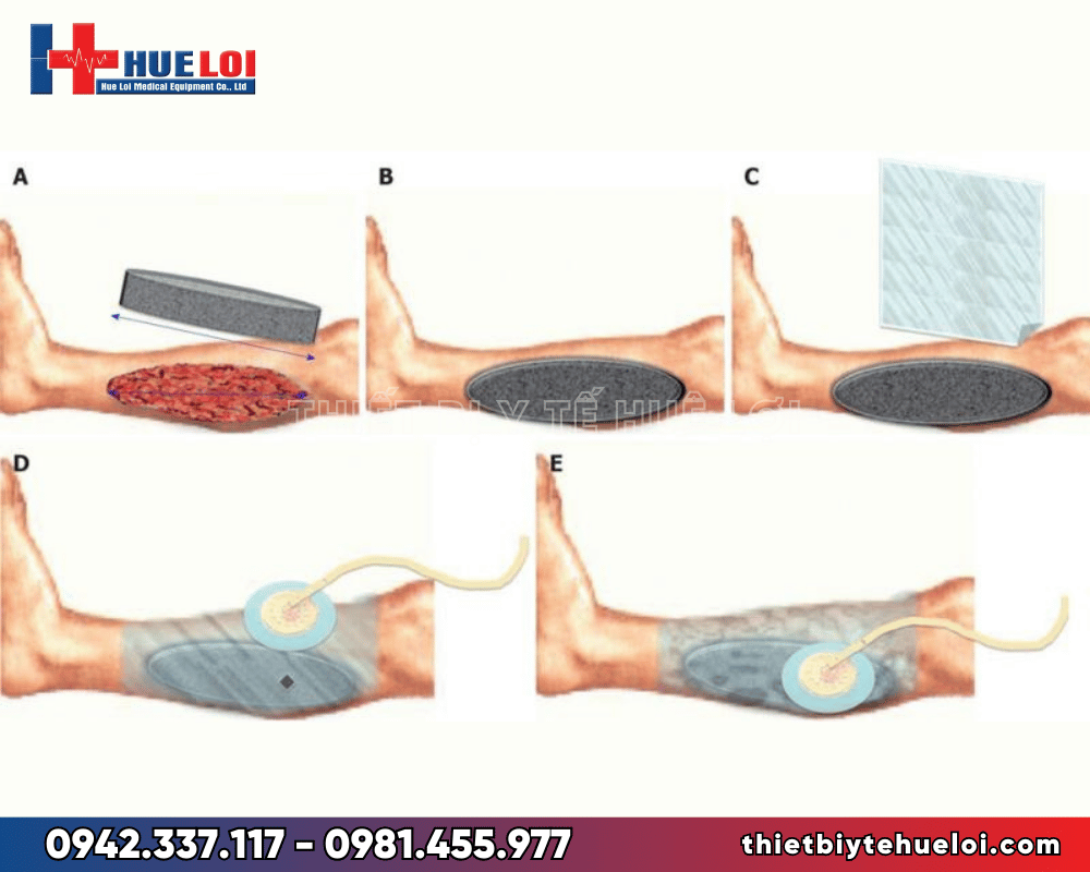 Máy hút áp lực âm điều trị vết thương giá rẻ